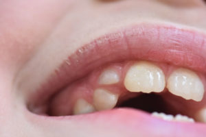 Kind mit Zahnfehlstellung