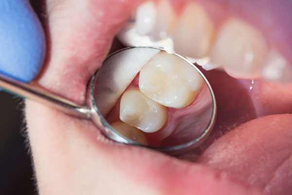 Zahnfarbene Füllung, im Dentalspiegel sichtbar