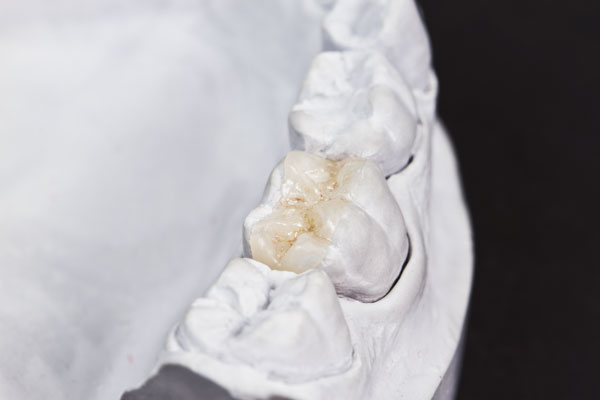 Zahnfarbenes Inlay in einem Gipsmodell